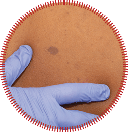 Young african woman with birthmark on her back skin. Checking benign moles. Neurofibromatosis