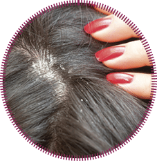 Persistent dandruff issue - flaky scalp