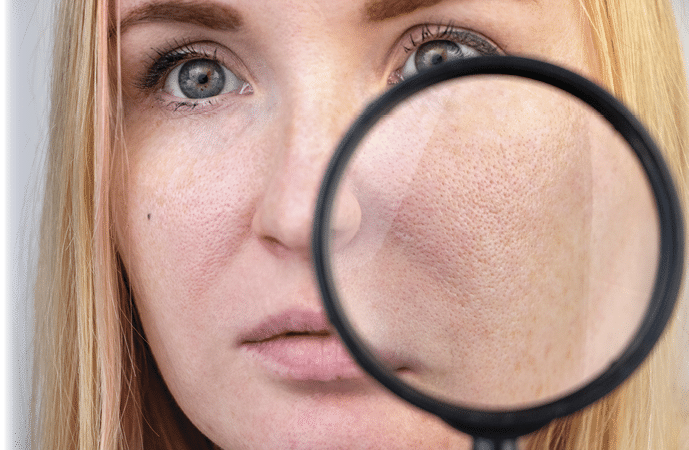 Enlarged pores, black spots, acne, rosacea close-up on the cheek. A woman is being examined by a doctor. Dermatologist examines the skin through a magnifier, a magnifying glass