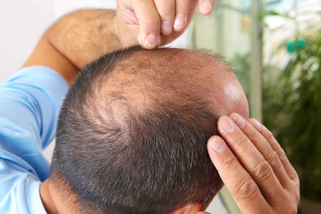 Beat hair loss with Planoxia-RG