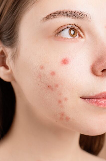 The benefits of zinc in calamine lotion